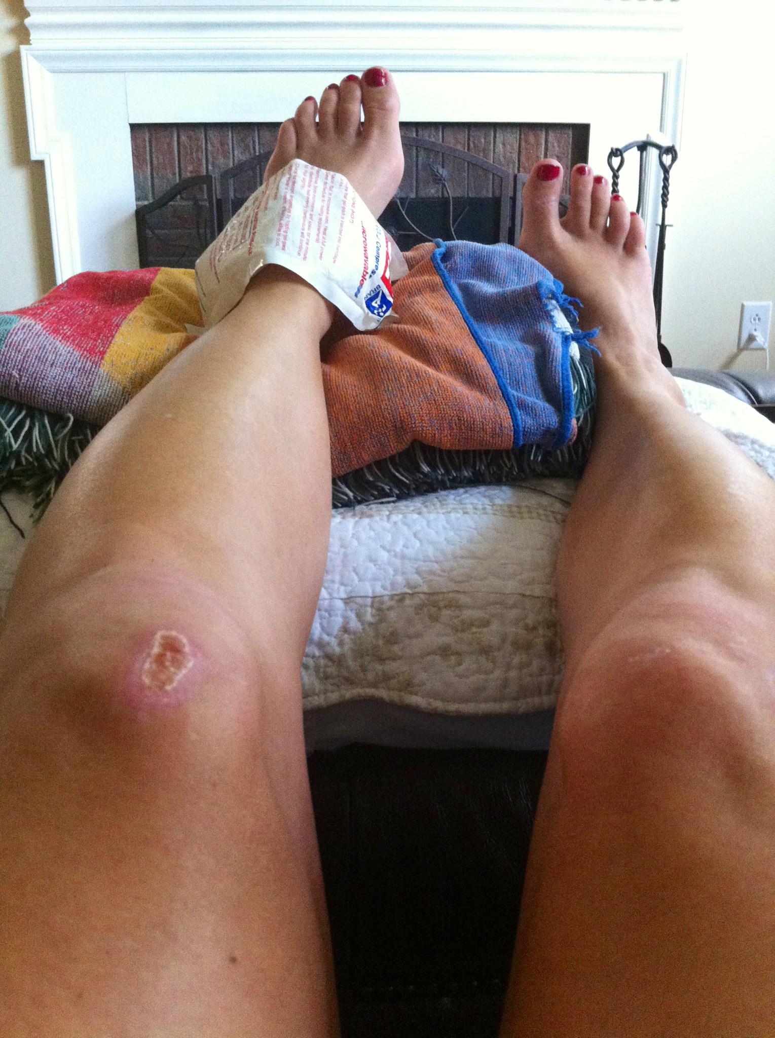 ankle icing